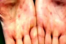 عدم فراگیری آبله میمونی در ایران/ ویروس تاکنون جهش خطرناکی نداشته است