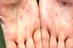 عدم فراگیری آبله میمونی در ایران/ ویروس تاکنون جهش خطرناکی نداشته است