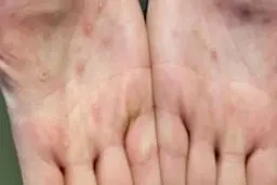 عدم فراگیری آبله میمونی در ایران/ ویروس تاکنون جهش خطرناکی نداشته است