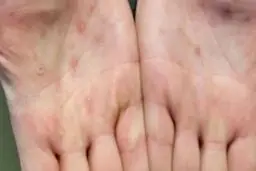 عدم فراگیری آبله میمونی در ایران/ ویروس تاکنون جهش خطرناکی نداشته است